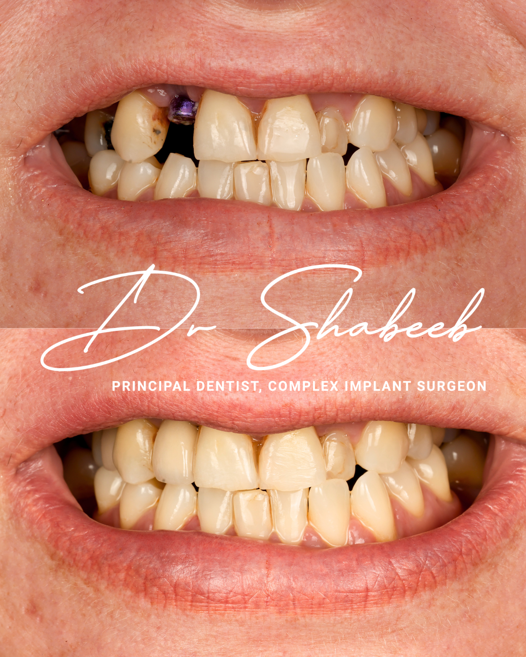 5 Dental implants