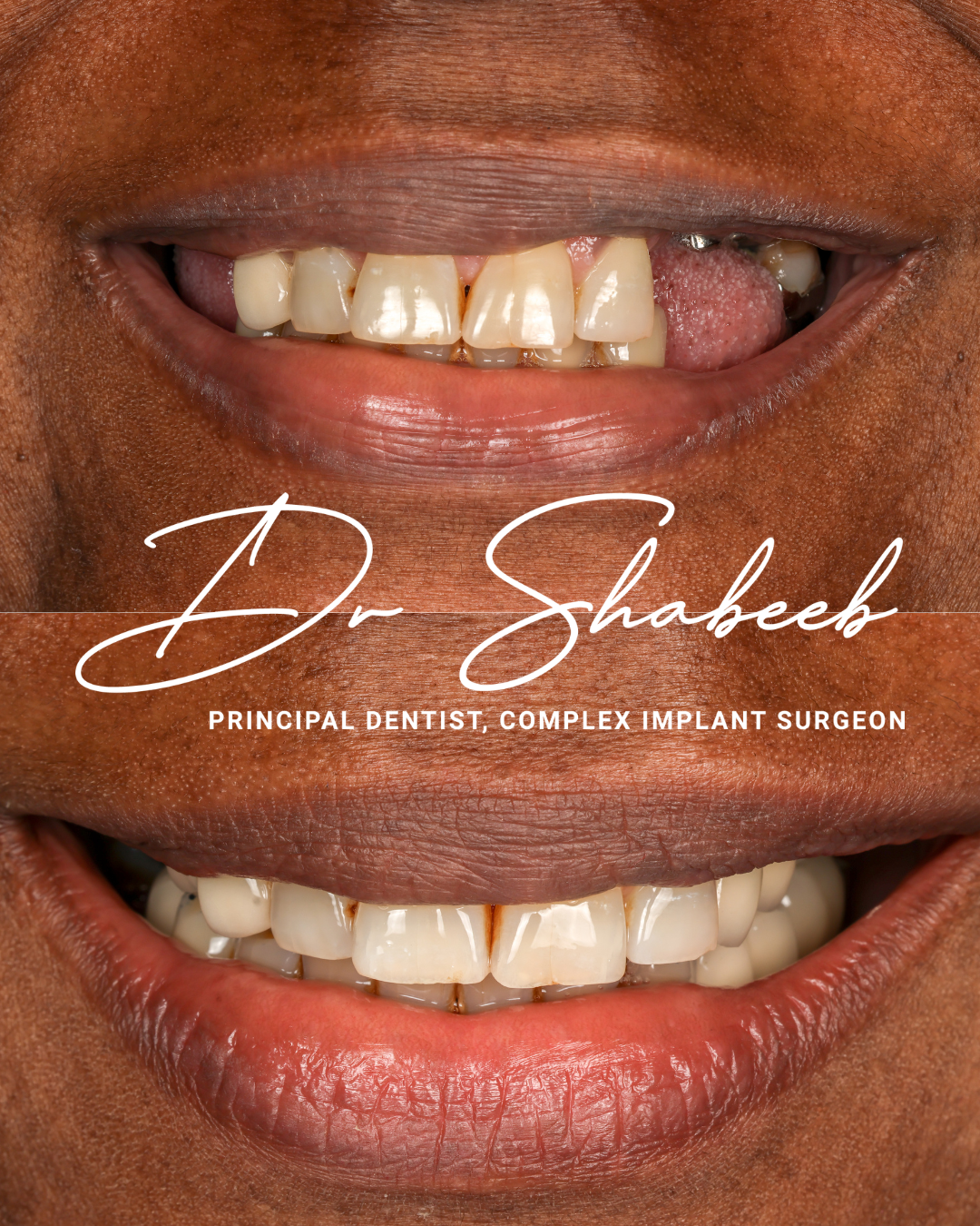 6 Dental implants