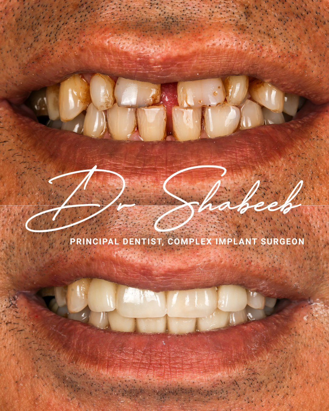 Veneers 1