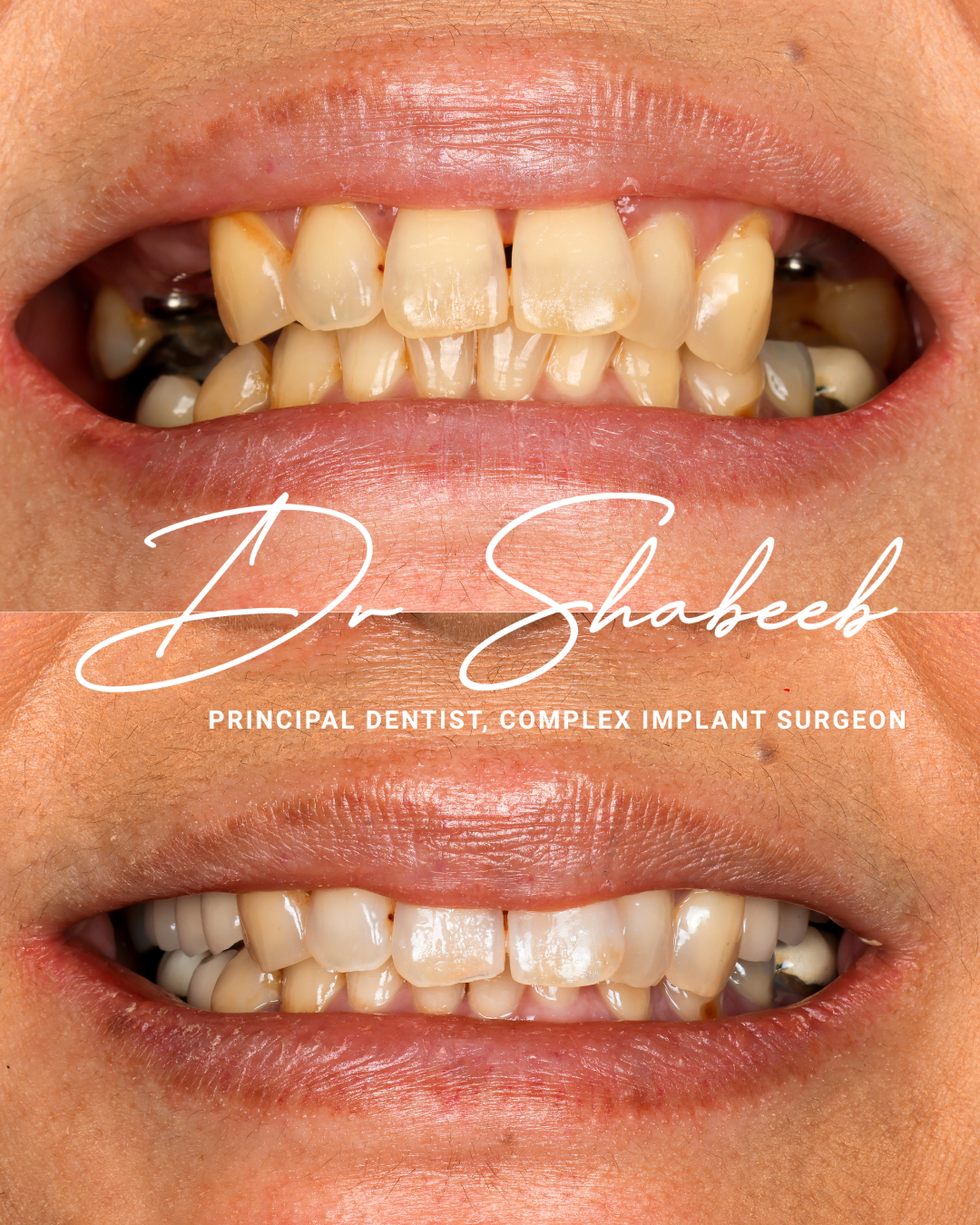 4 Dental implants