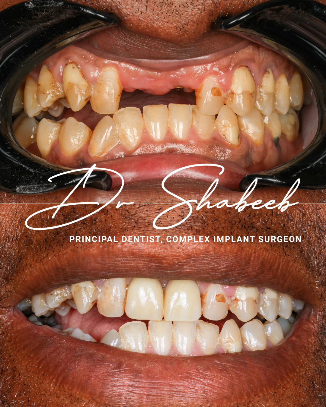 1 Dental implants