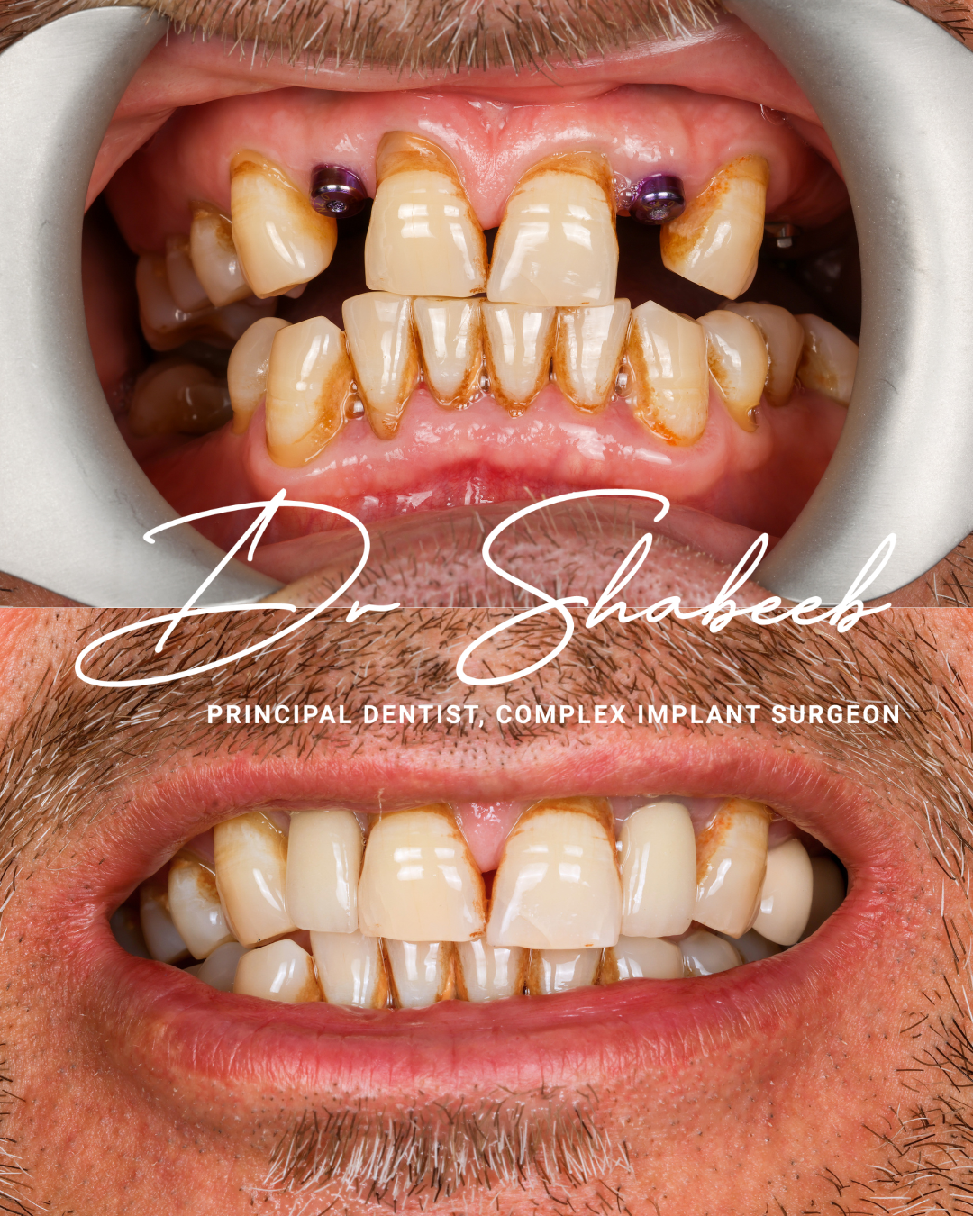 2 Dental implants