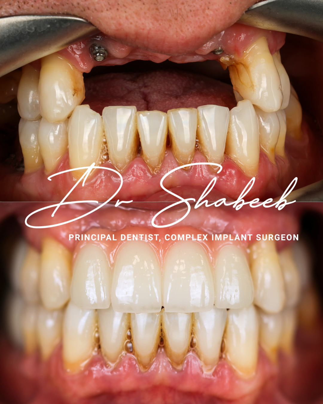3 Dental implants