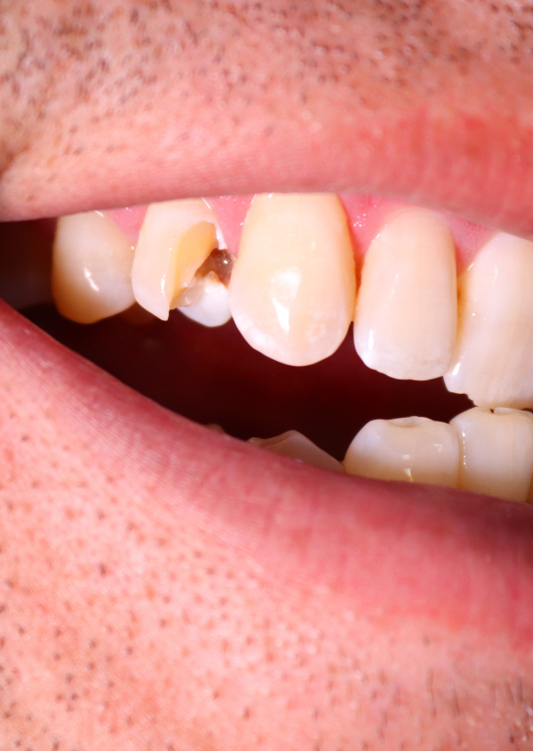 Broken_Cracked Tooth