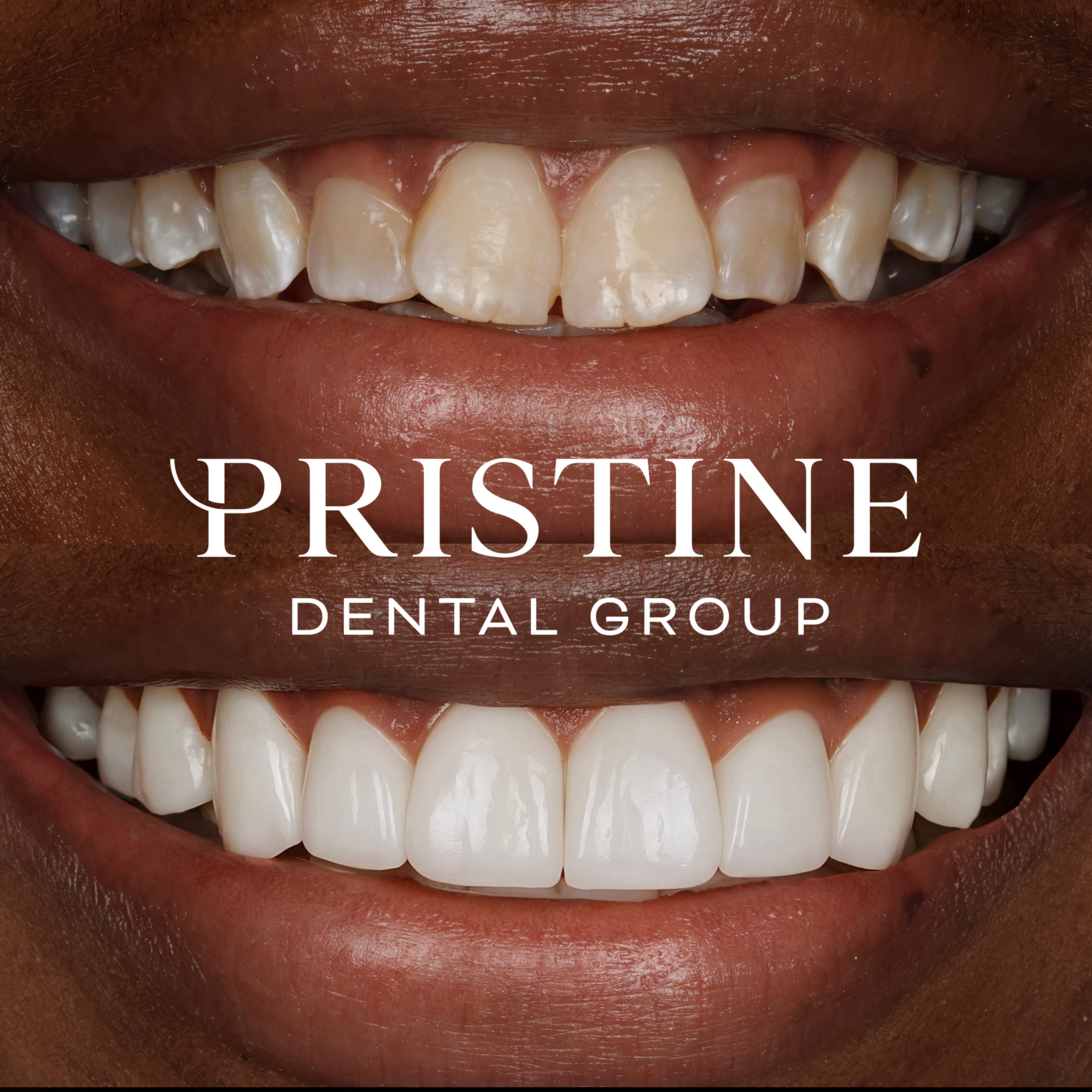 Composite and whitening (1)