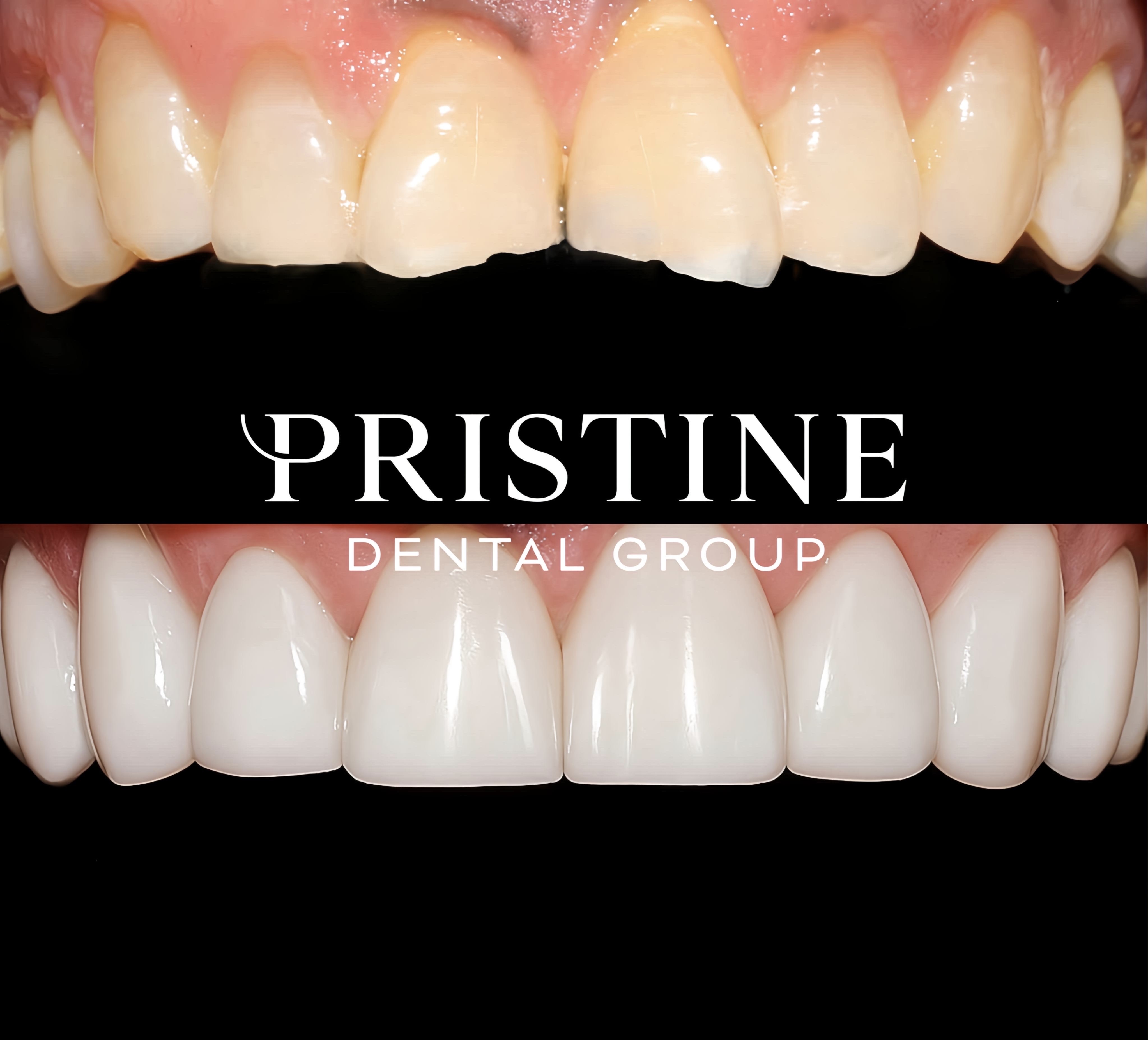 Composite and whitening (2)
