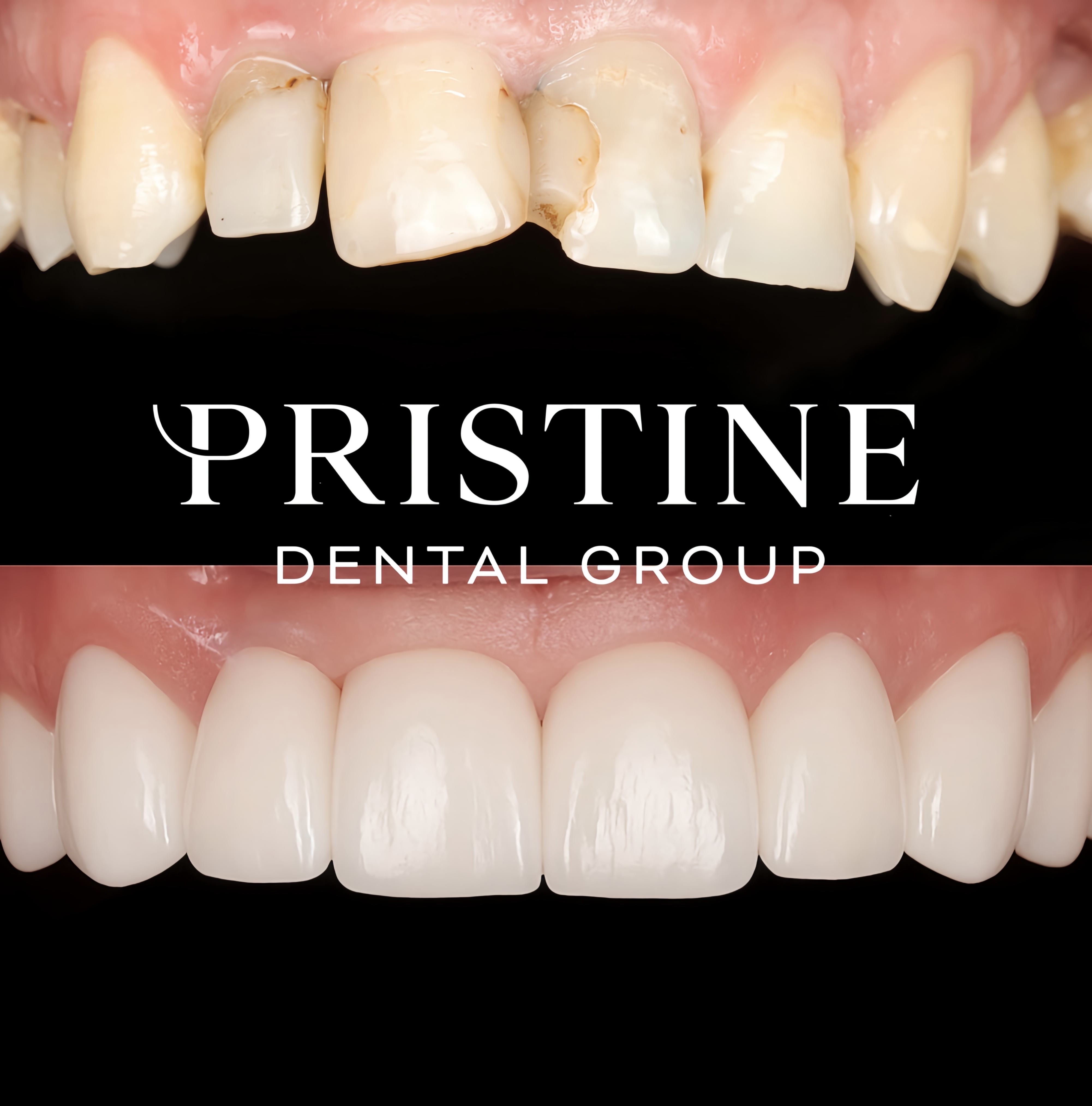 Composite bonding (5)