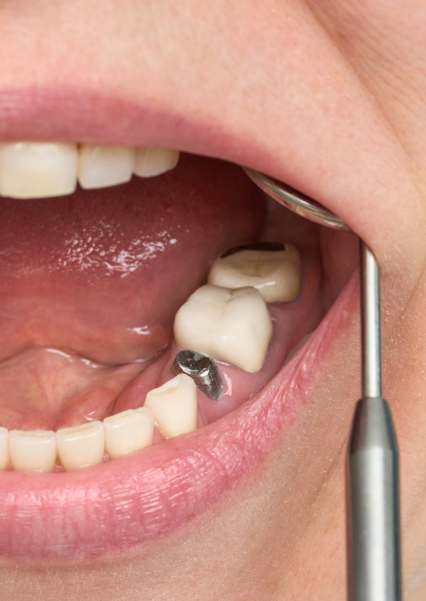 Immediate Dental Implants After Extraction