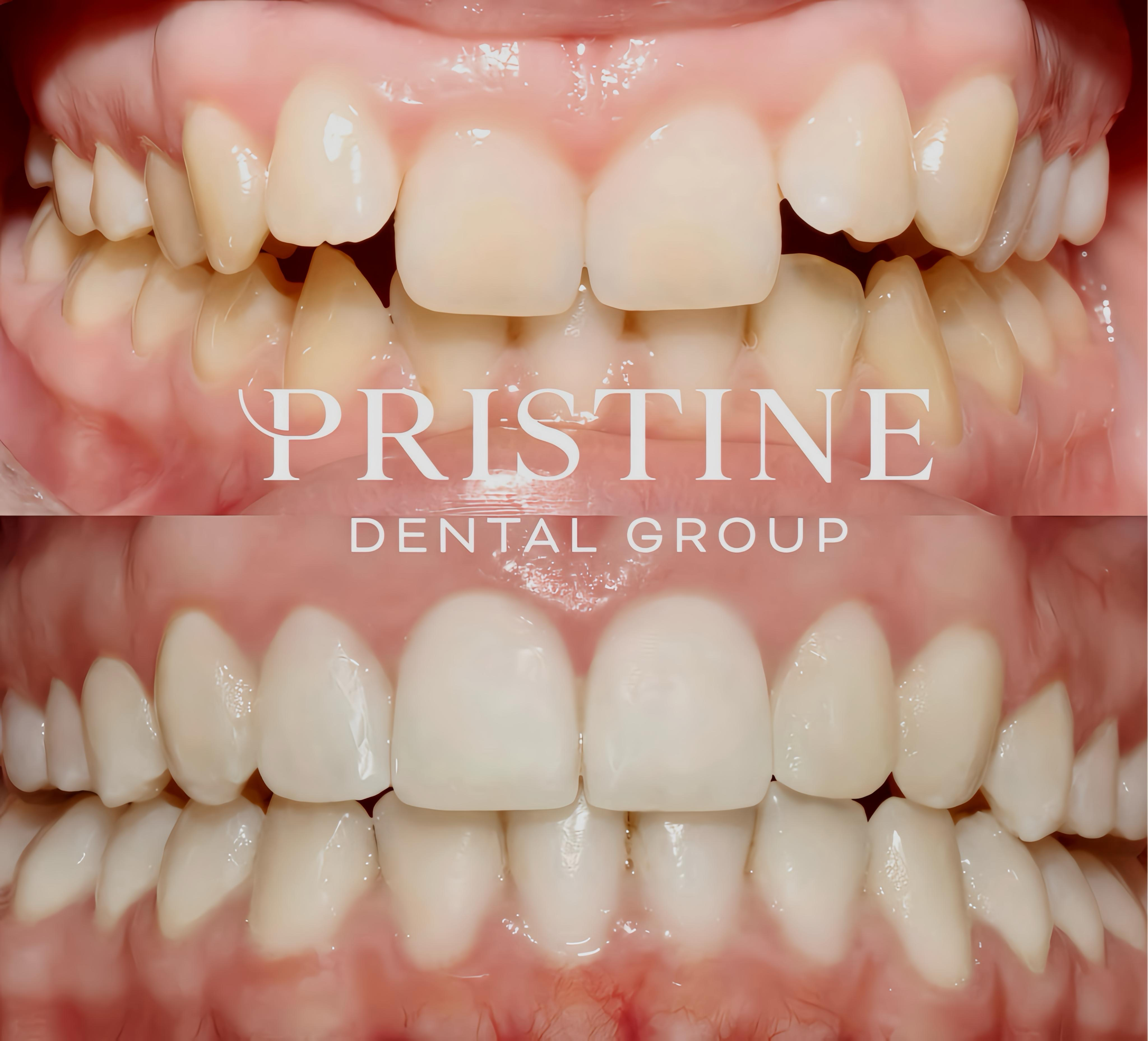 Clear aligner, whitening, composite bonding _