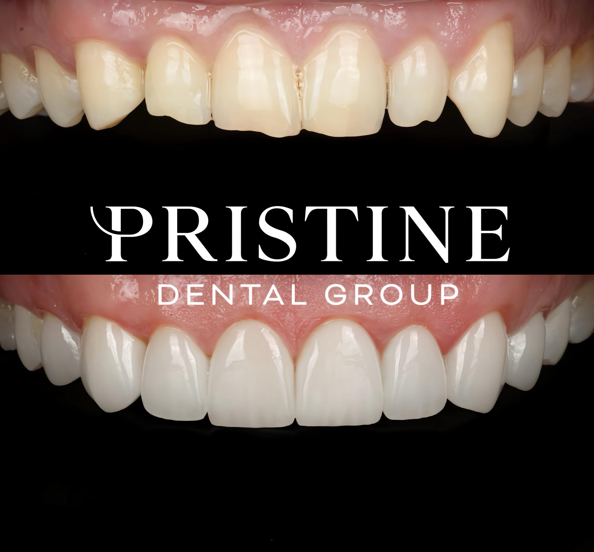 Veneers_2