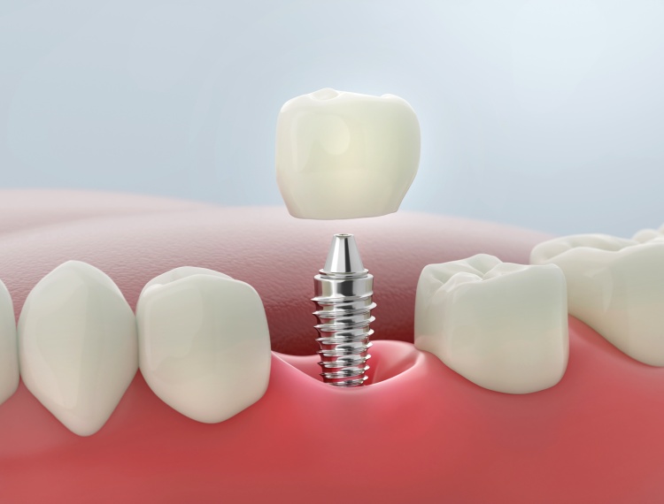 When is an immediate implant suitable