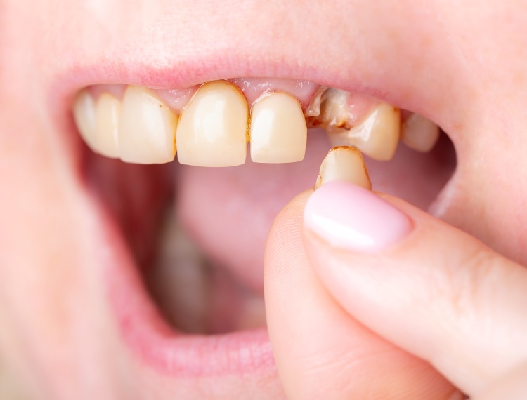 broken tooth piece