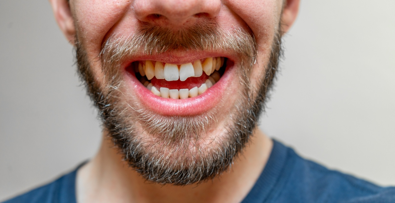 chipped tooth
