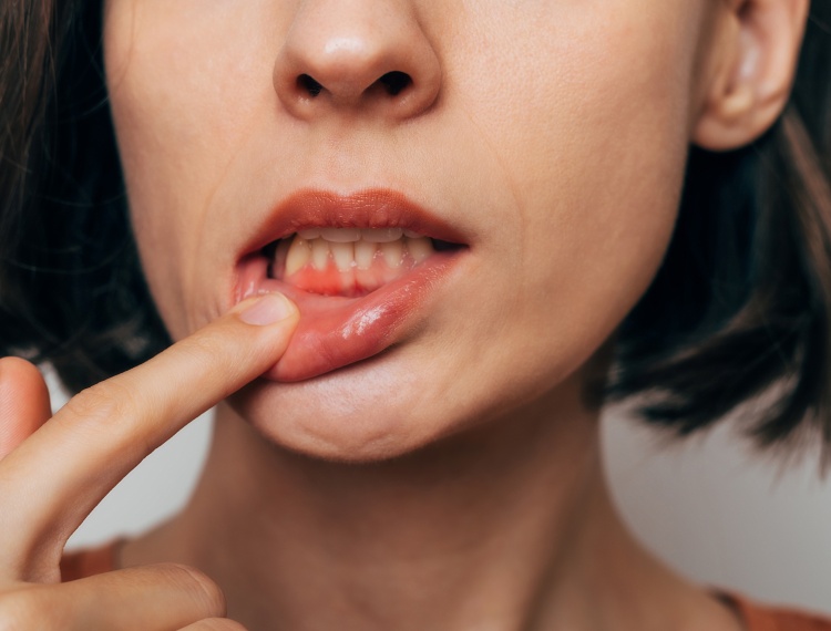 gum inflammation