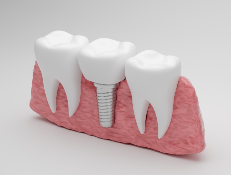 implant